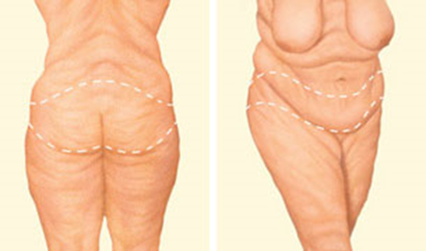 Body Lift Incisions
